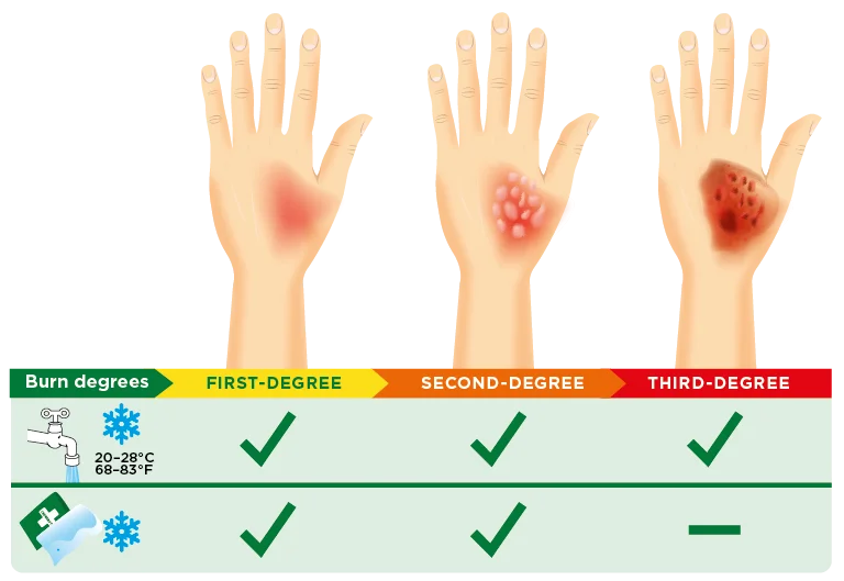 Illustrasjon av ulike grader av brannskader på hender